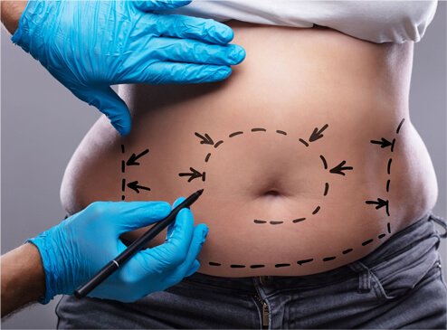ABDOMINOPLASTIE