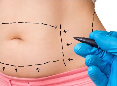 LIPOSUCCION