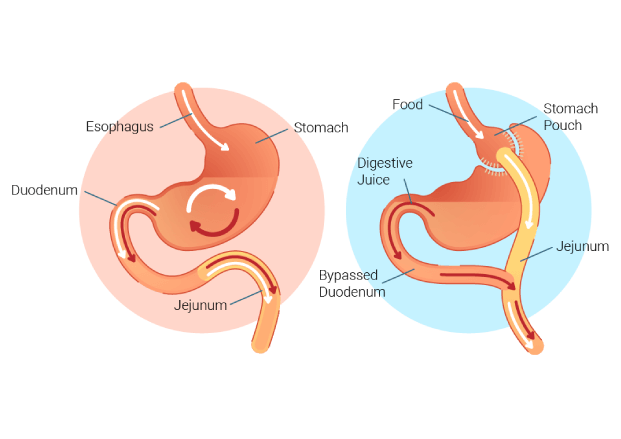 gastric bypass