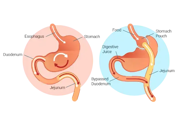 gastric bypass