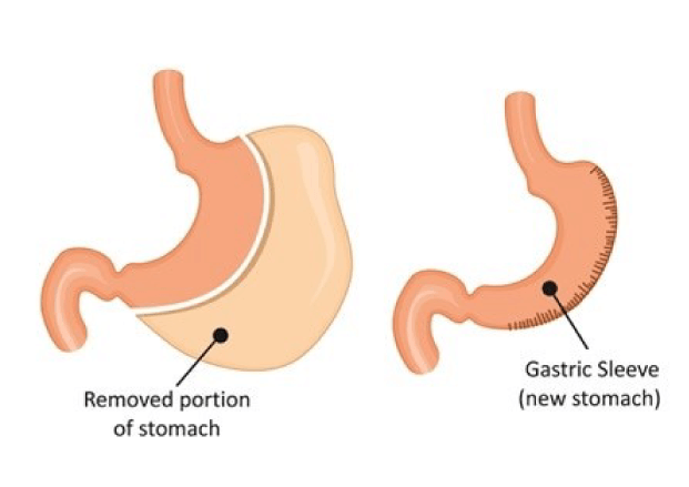 vertical gastric sleeve