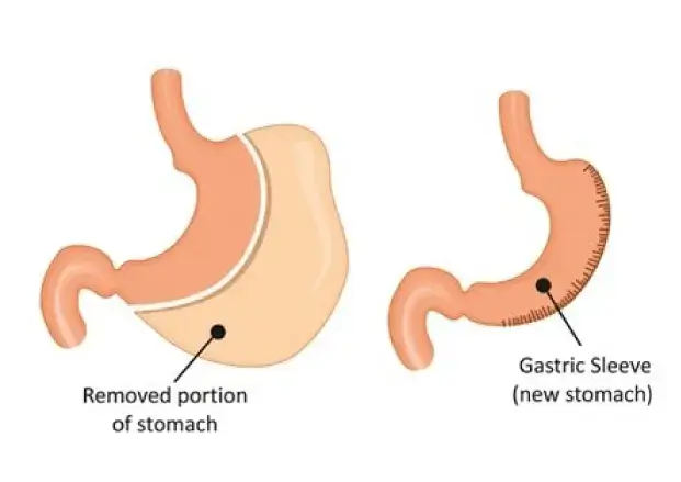 vertical gastric sleeve